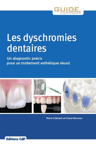 Les dyschromies dentaires : un diagnostic précis pour un traitement esthétique réussi